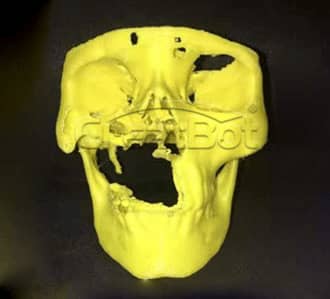Humerus&Upper jawbone PEEK implant 01