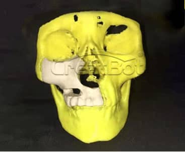 Humerus&Upper jawbone PEEK implant 02