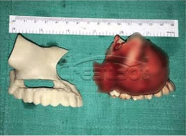 Humerus&Upper jawbone PEEK implant 05