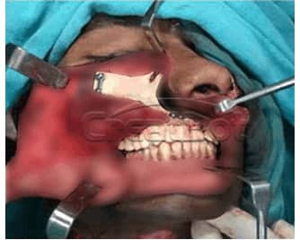 Humerus&Upper jawbone PEEK implant 06