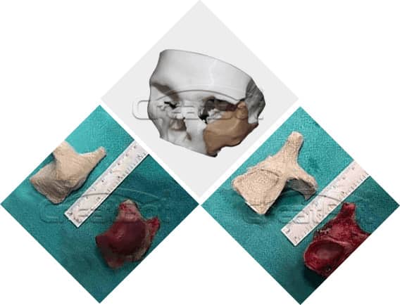 Parietal bone PEEK implant 01