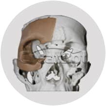 Os lacrimale&cheekbone PEEK implant 01