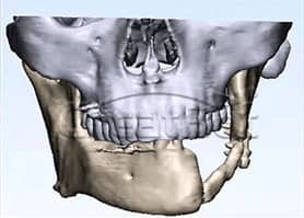 lower jawbone PEEK implant 05