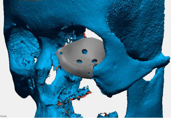 越南 Ngoc Bao Biomedical & CreatBot 3D打印
