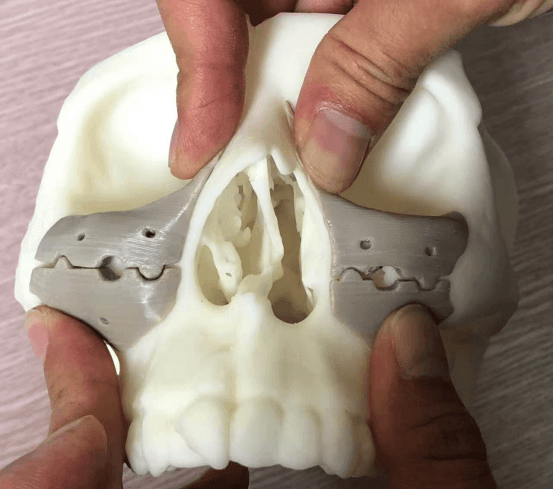 3D 打印 PEEK 鼻梁及眼眶模型